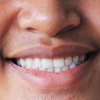 wybielanie zębów warszawa